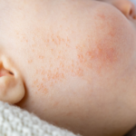 Baby Acne: Do Newborn Babies Really Get Acne?