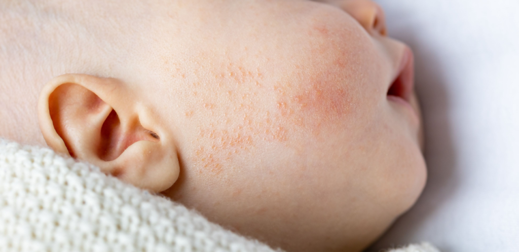 Baby Acne: Do Newborn Babies Really Get Acne?